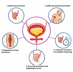 Symptoms and early warning signs of urethral stricture - weak stream, difficulty starting, infections, incomplete emptying, burning and dribbling
